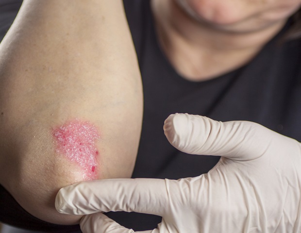 Breakthrough research identifies small peptide for psoriasis treatment