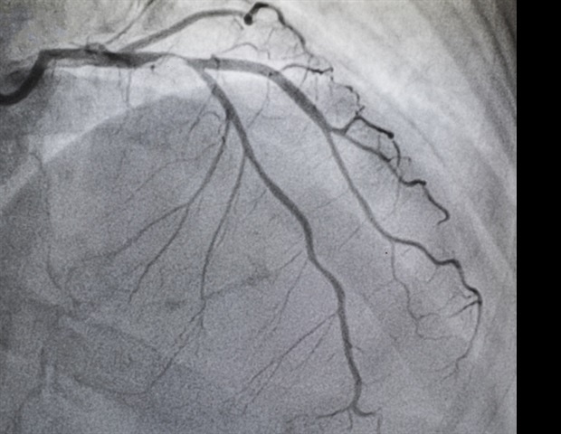 Study shows safe outcomes for PCI performed in ambulatory surgery centers