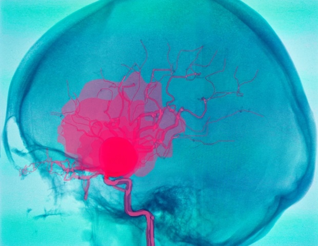 New biomarkers and therapeutic targets identified for abdominal aortic aneurysm