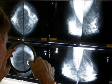 Cancer before age 50 is increasing. A new study looks at which types