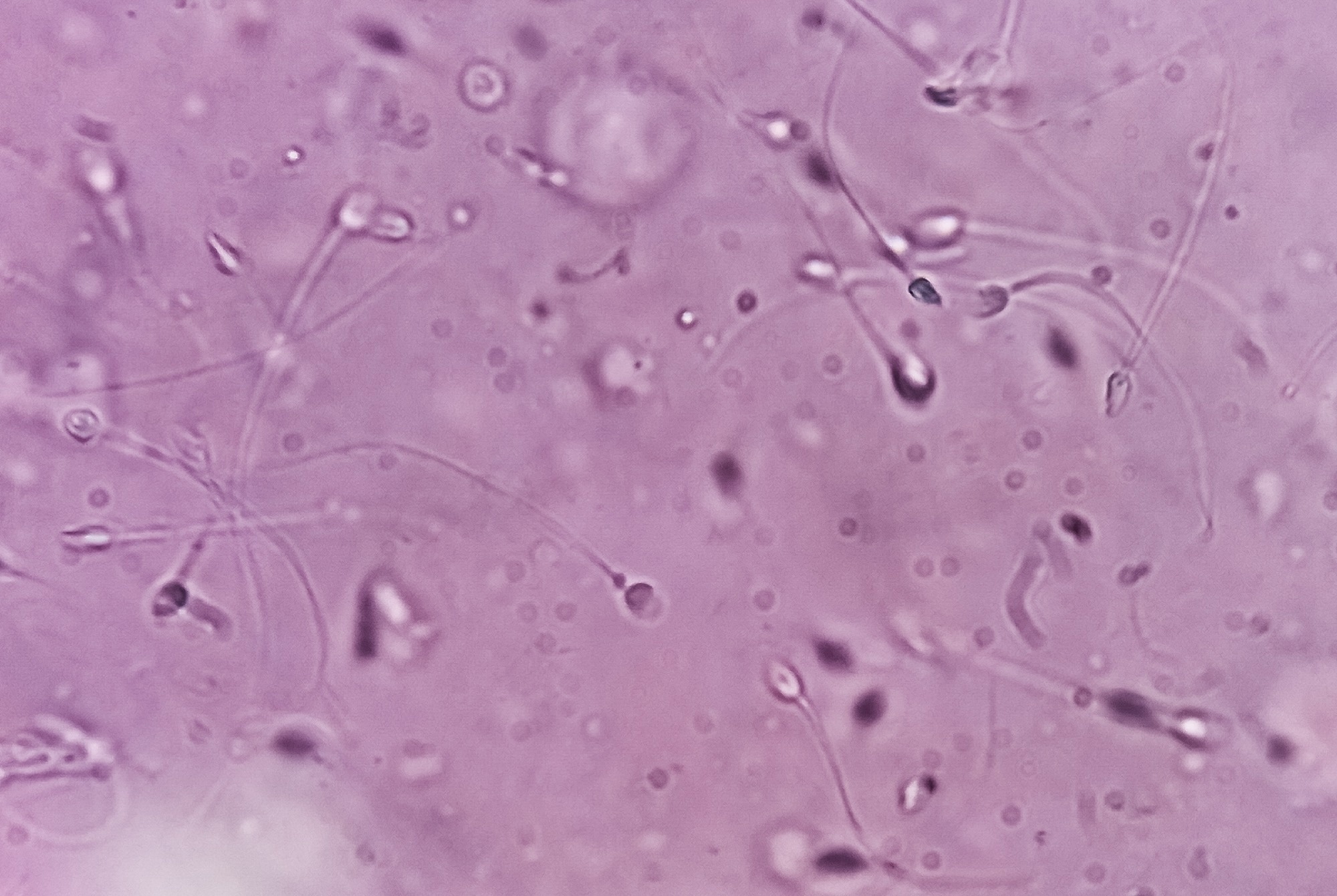 Low phosphate levels may help explain male infertility, study finds