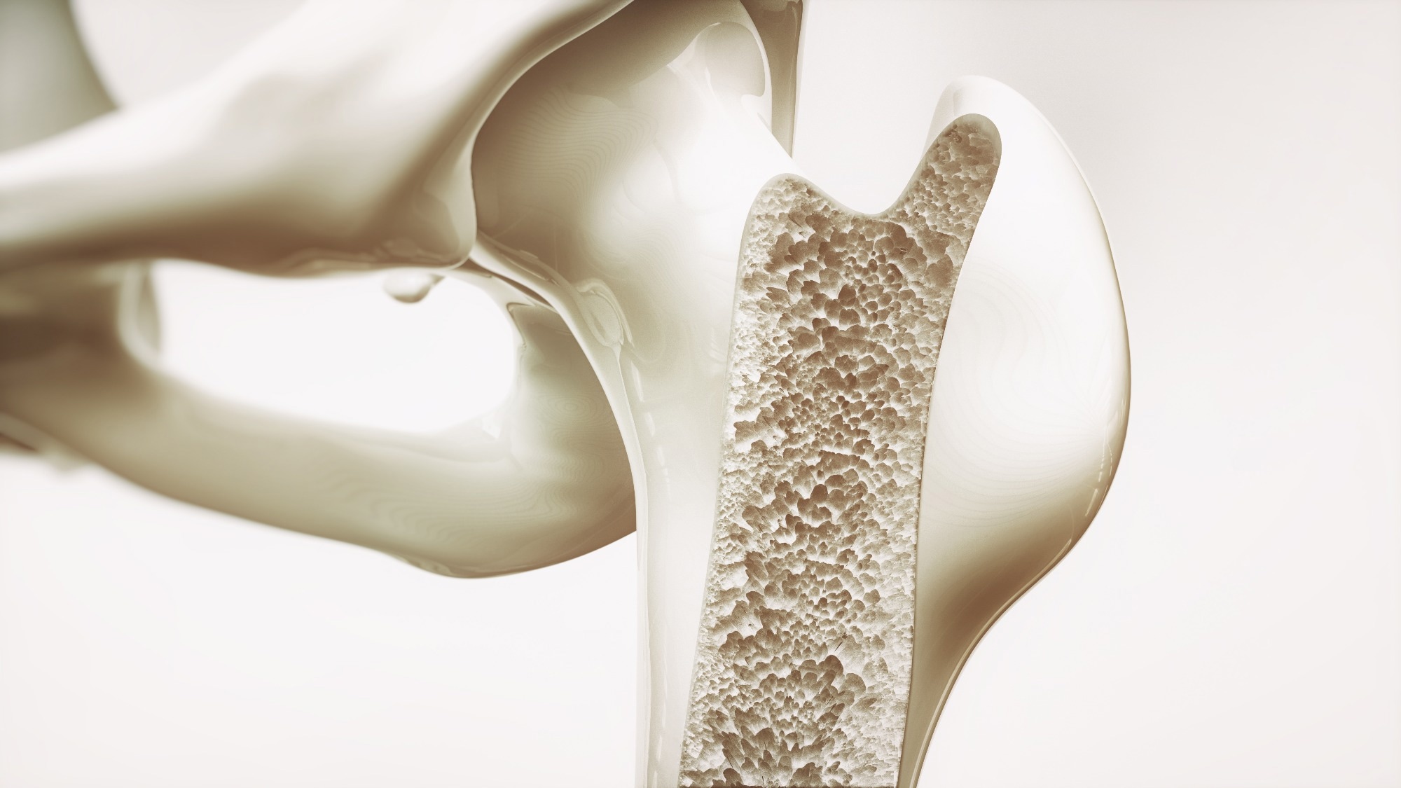 Lipid buildup predicts weaker bones once it passes a critical threshold