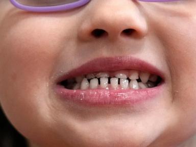 FDA and RFK Jr. aim to remove fluoride supplements used to protect kids’ teeth