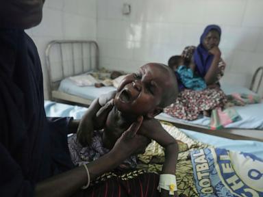 Children die as USAID aid cuts snap a lifeline for the world’s most malnourished