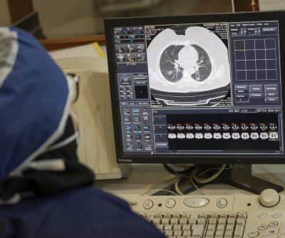 Lung cancer risk in never-smokers predicted by AI tool ‘Sybil’