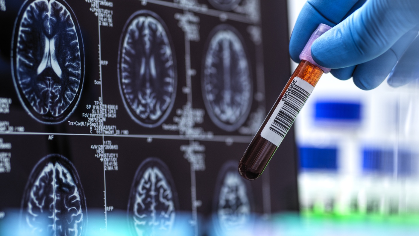 First FDA-cleared Alzheimer’s blood test could make diagnoses faster, more accurate