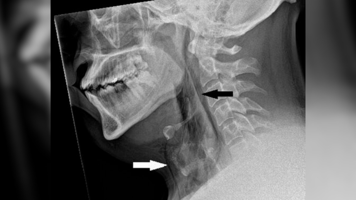 Diagnostic dilemma: A man held in a sneeze — and it punctured his windpipe