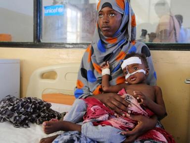 US aid kept many hungry Somali children alive. Now that money is disappearing
