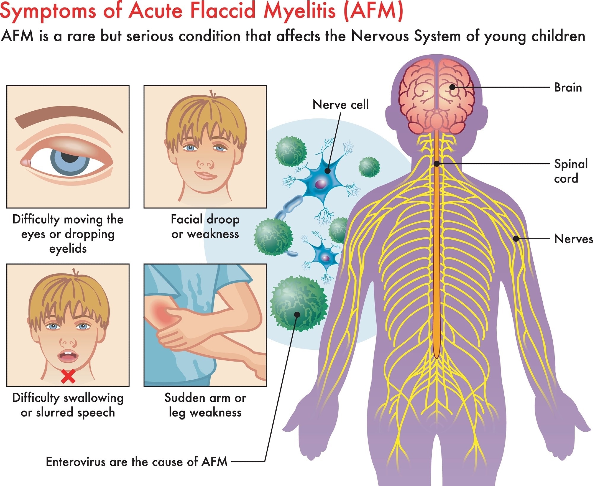 Gaps in surveillance leave European children at risk of acute flaccid myelitis