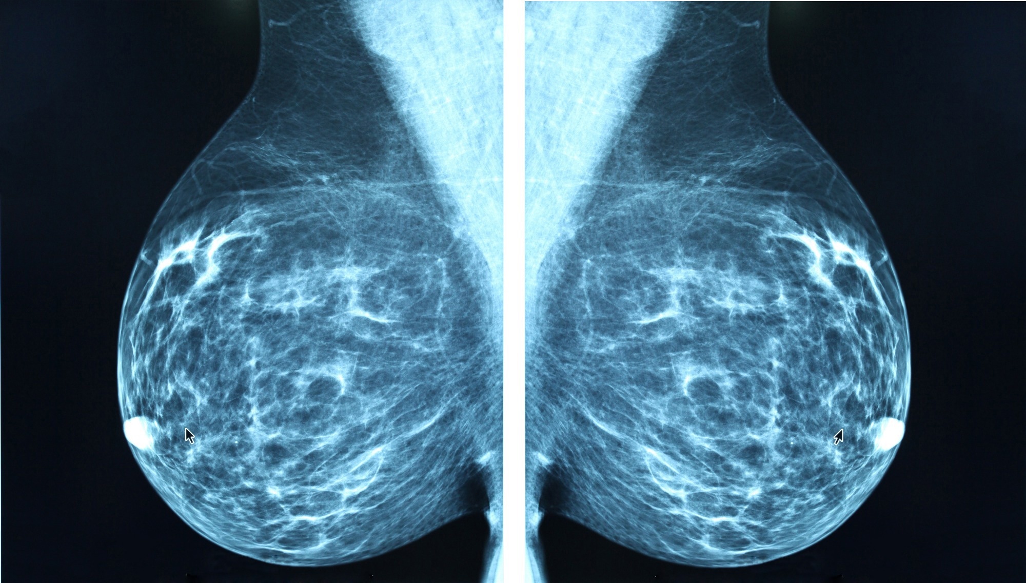 AI spots future breast cancer risk in mammograms years before diagnosis