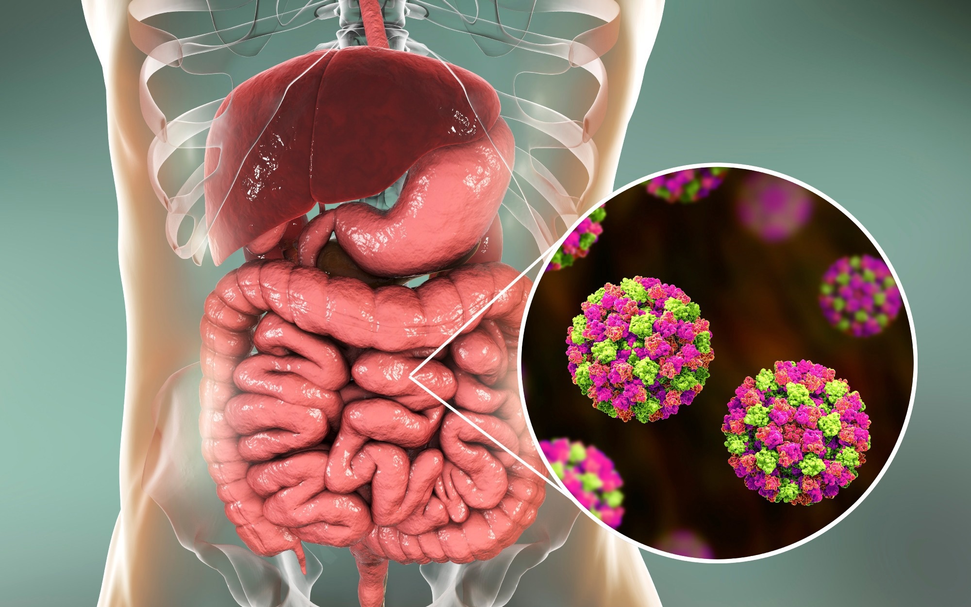 Norovirus GII.17 overtakes GII.4 as the dominant strain in US outbreaks