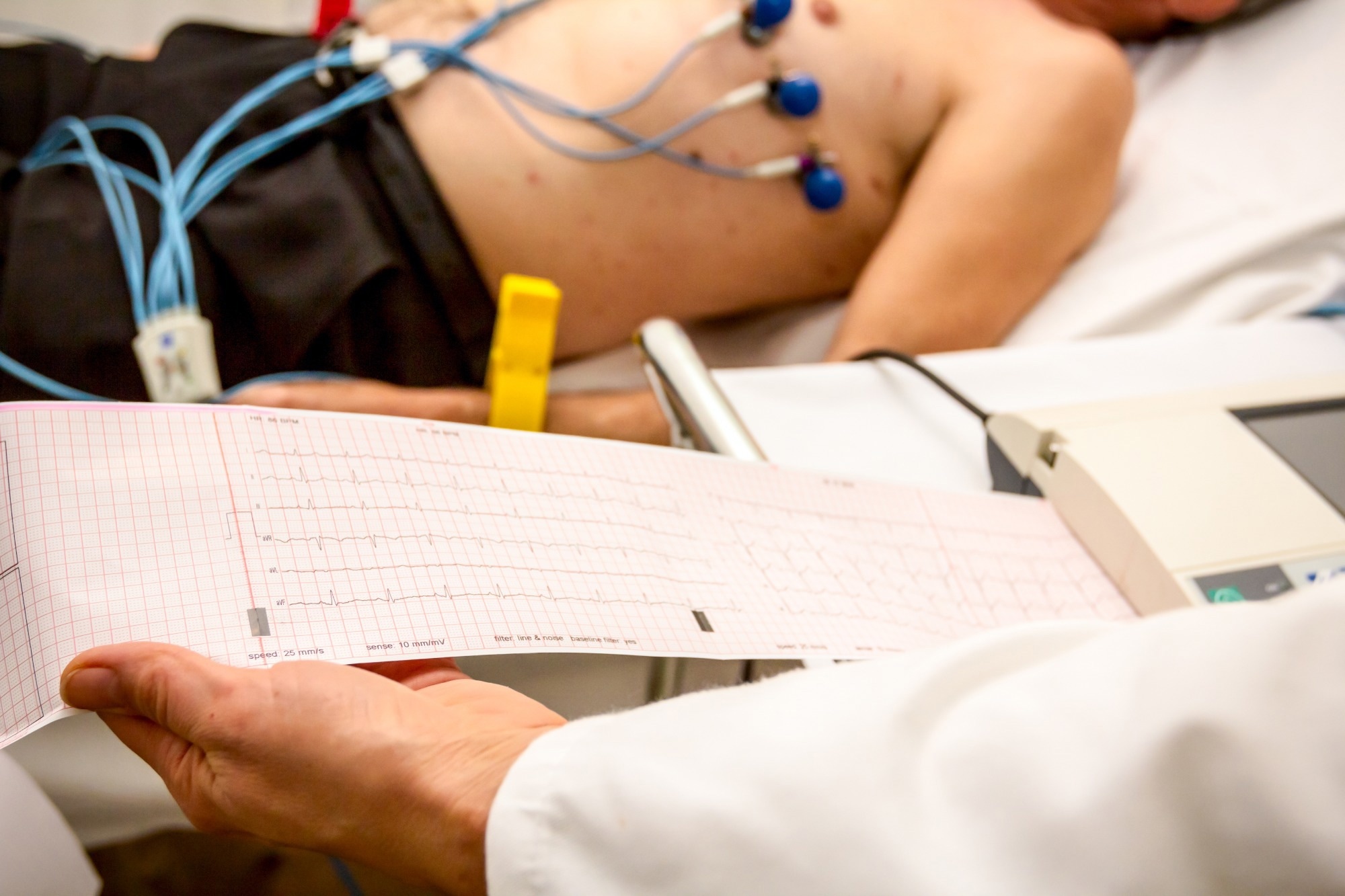 America slashes heart attack deaths but faces surge in deadly heart failure and arrhythmias