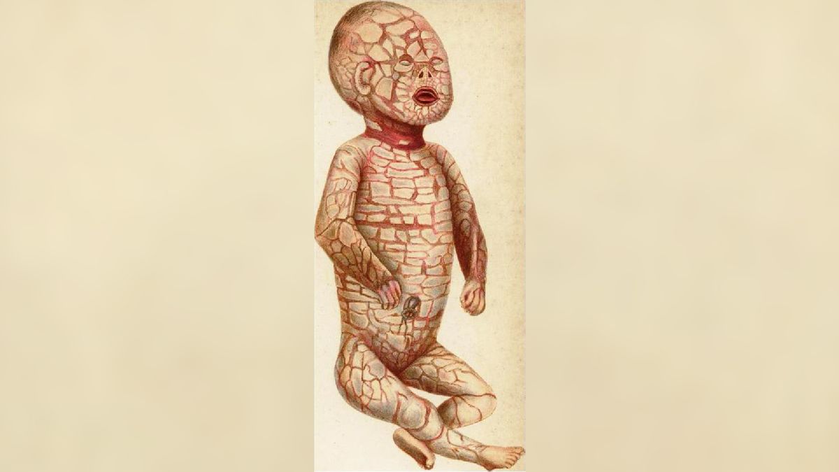 Harlequin ichthyosis: The rare genetic disease that gives babies hard ‘scales’