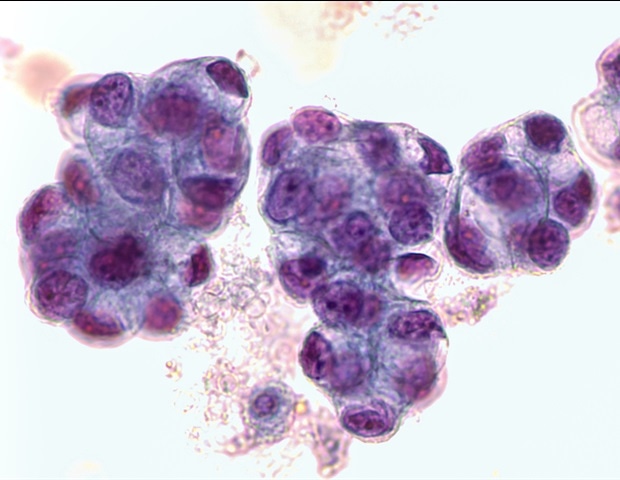 Organ chip technology accurately predicts chemotherapy response in esophageal adenocarcinoma patients