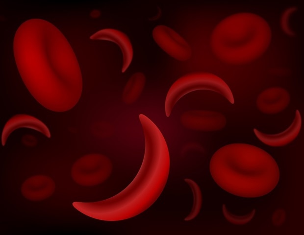 Gene therapy shows promise for reducing stroke risk in patients with sickle cell disease
