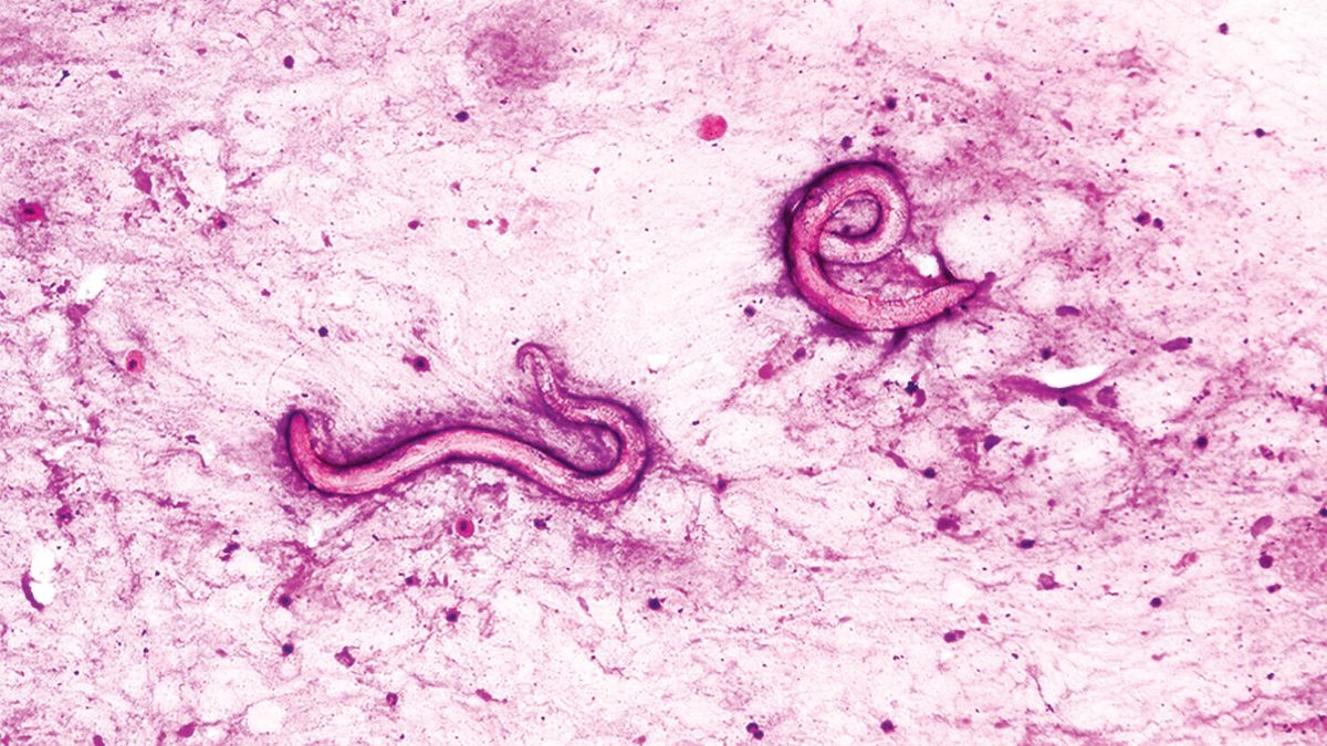 Man’s body crawling with parasitic worms after infected kidney transplant at US hospital