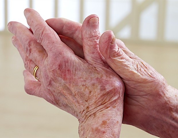 New study maps cellular fingerprints driving childhood arthritis
