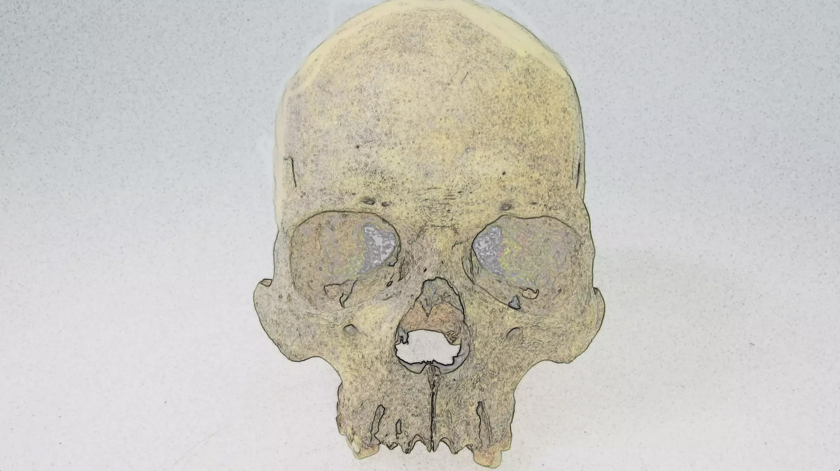 Rare form of leprosy infected people in Americas before European arrival, 4,000-year-old bones suggest