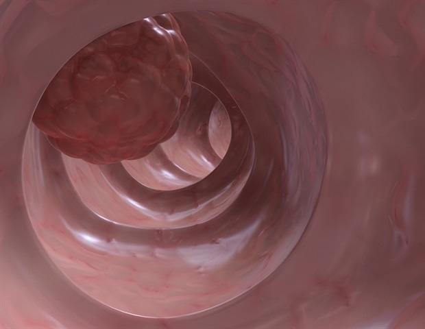Early-onset gastrointestinal cancer rates rising across the globe