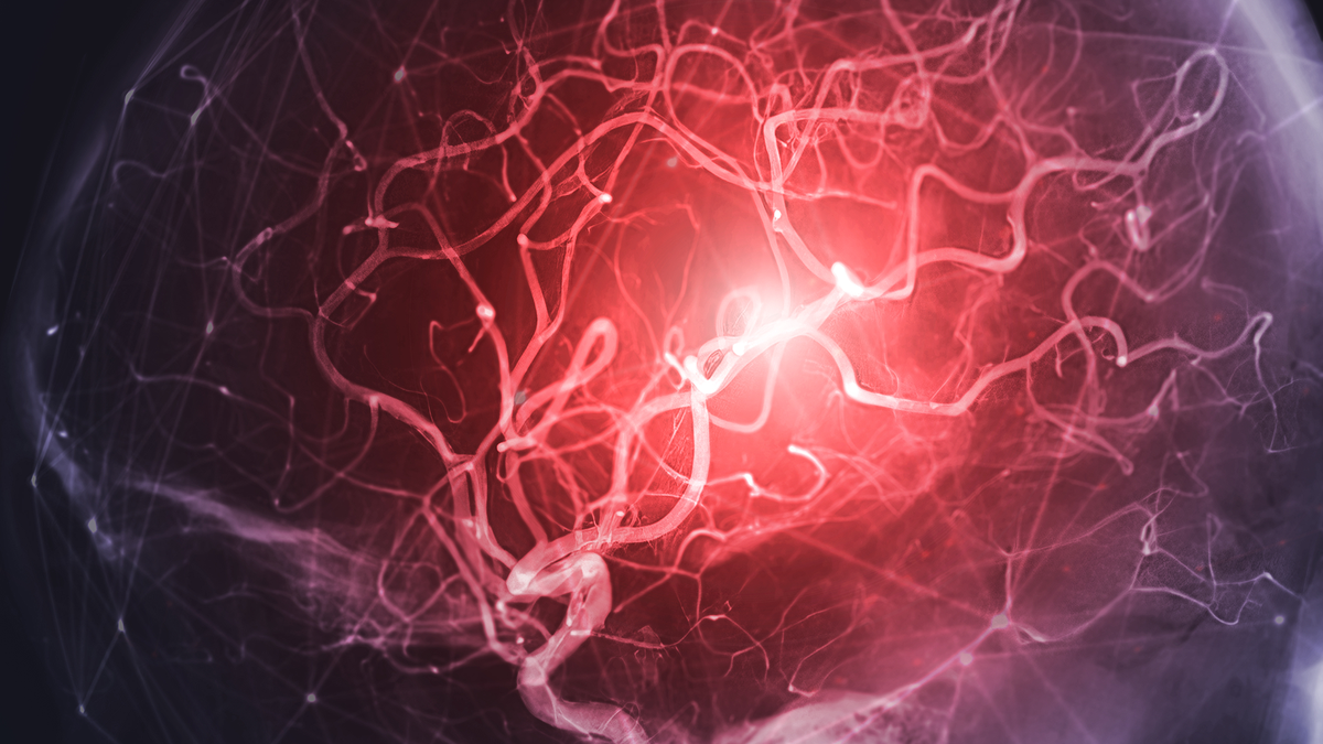 Diagnostic dilemma: Orgasm involving a kitchen whisk likely triggered person’s fatal aneurysm