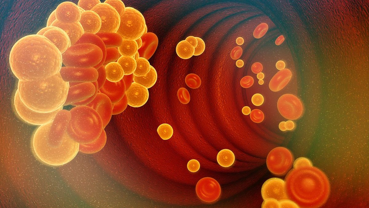 Experimental treatment for high cholesterol edits DNA in the body to reduce LDL
