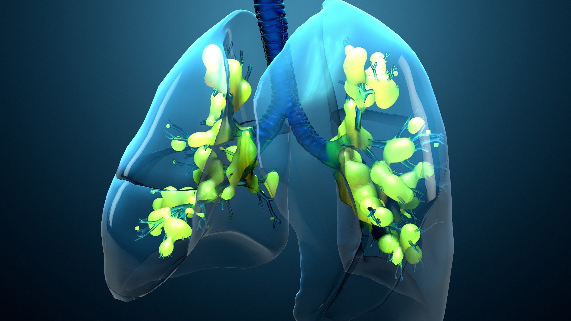 AI reshapes ARDS care by predicting risk, guiding ventilation, and personalizing treatment