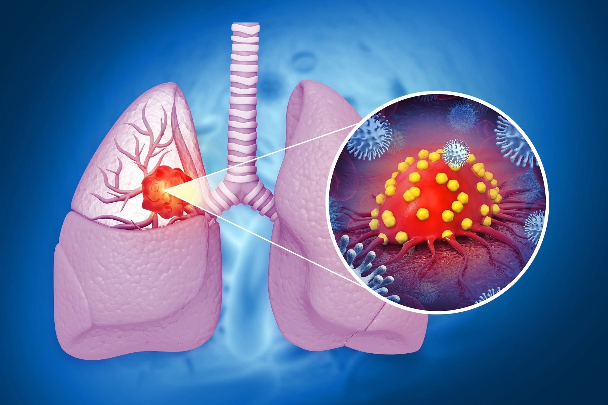 Allergies linked to lower lung cancer risk, new study finds