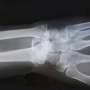 Study finds stopping HRT leads to a period of higher risk of bone fracture for most women