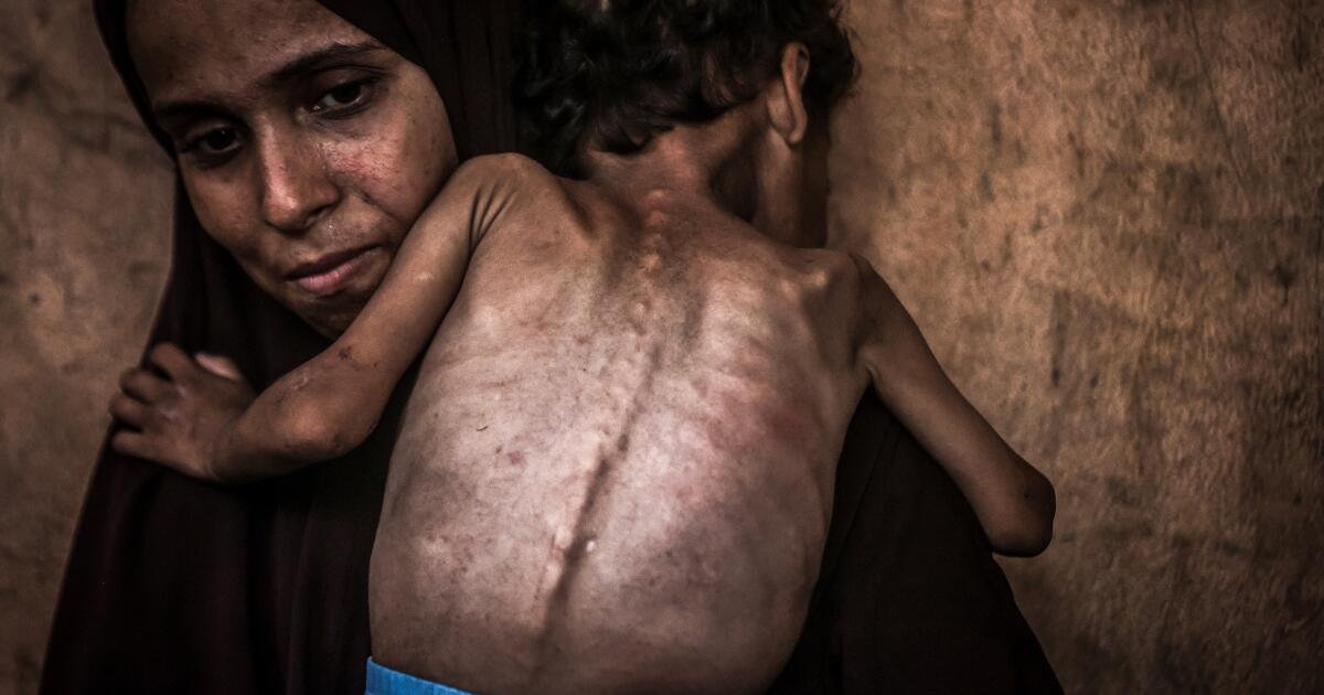 Famine’s toll on the children of Gaza: The world shouldn’t look away