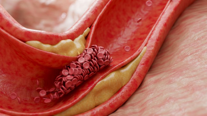 A molecule produced by gut microbes may help spur heart disease