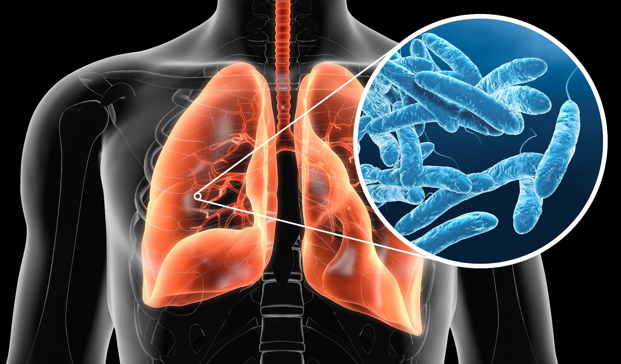 New Swiss study probes lingering fatigue after Legionnaires’ disease