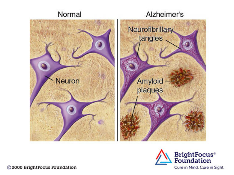 Lithium and Alzheimer’s Disease