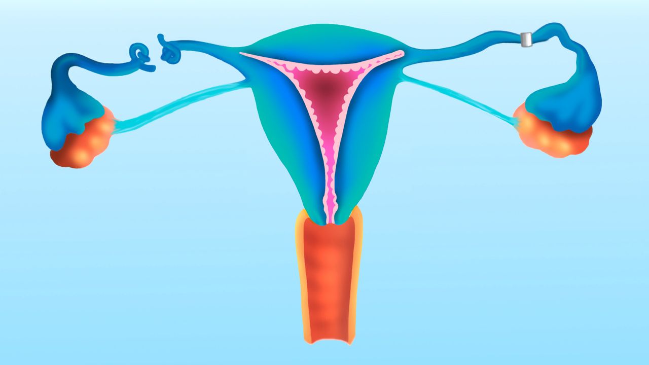 How does ‘getting your tubes tied’ work?