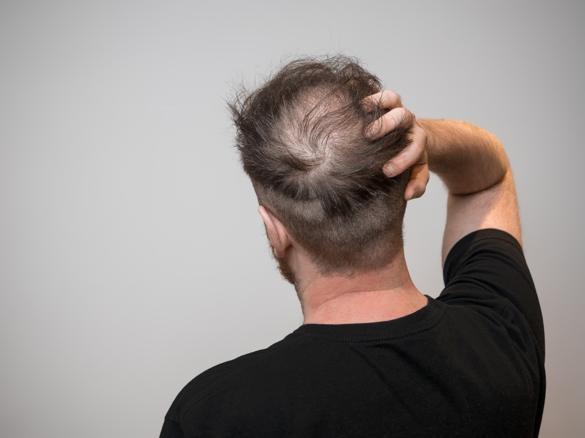 Sugary drinks increase hair loss risk, scientists warn