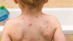 Children to be offered chickenpox vaccine on NHS