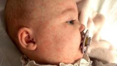 Vaccination plea after baby’s ‘terrifying’ measles