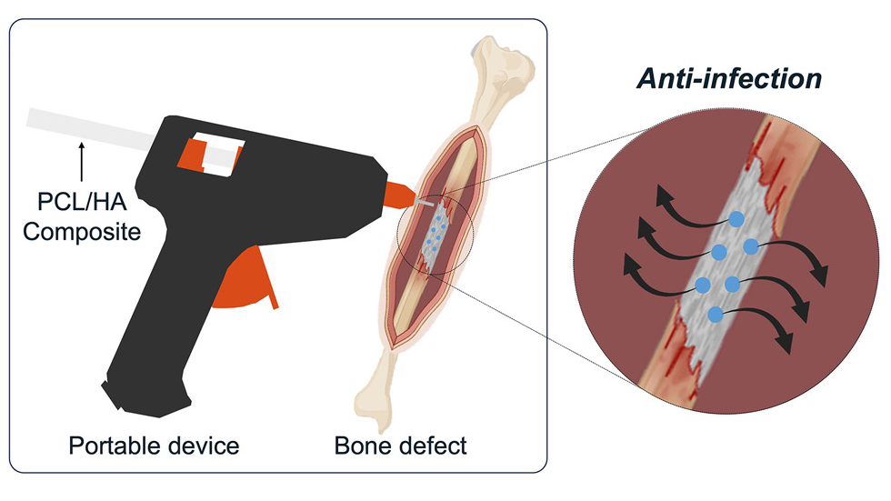Scientists develop ‘glue gun’ that 3D prints bone grafts directly onto fractures