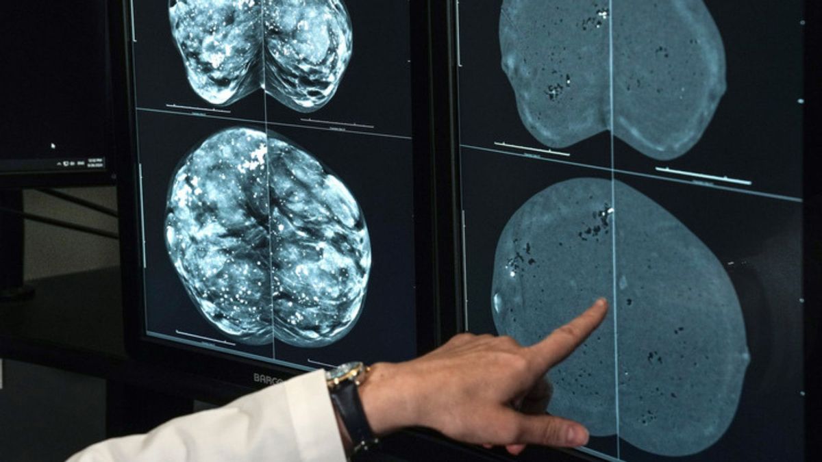 No, Switzerland didn’t ban mammograms over radiation risks, false positives