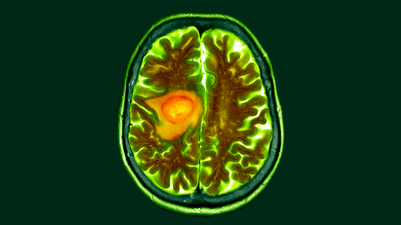 Diet change could make brain cancer easier to treat, early study hints