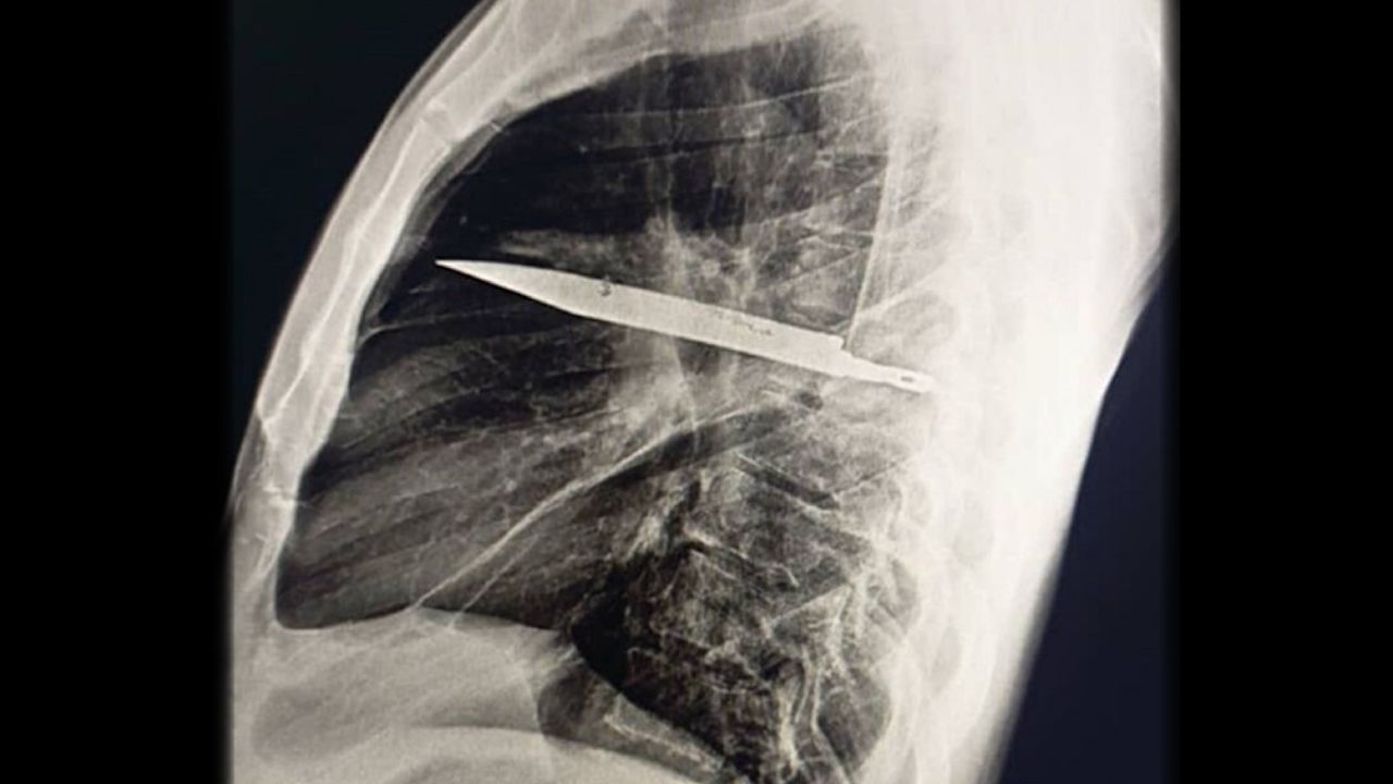 Diagnostic dilemma: A knife broke off in a man’s chest, and he didn’t notice it for 8 years