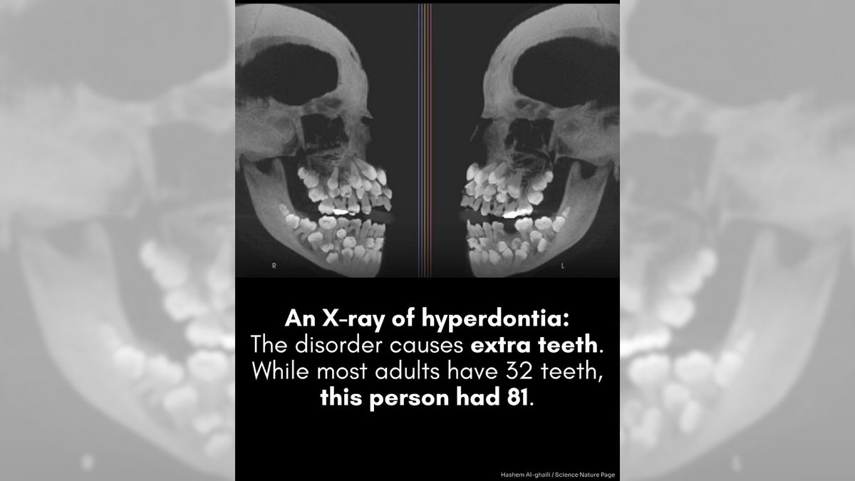 Real X-rays of person with 81 teeth?