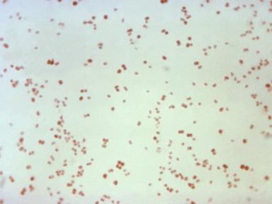 Sexually transmitted disease cases fall, but not syphilis in newborns