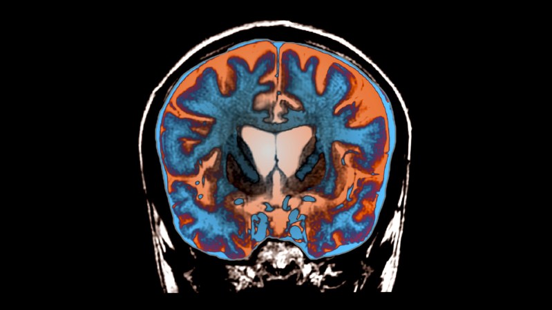 In a first, Huntington’s disease is slowed by an experimental treatment
