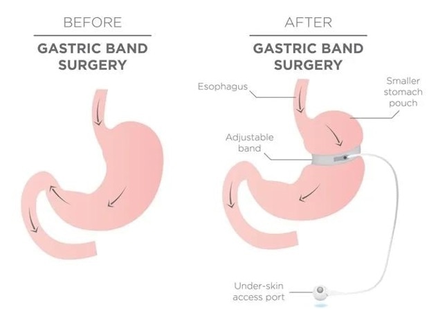 Study finds surge in the use of weight loss drugs among bariatric surgery patients