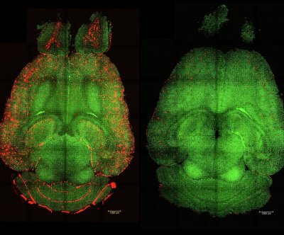 Scientists use nanoparticles to clear Alzheimer’s brain plaque in mice