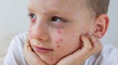 What is chickenpox and how can I get my child vaccinated?
