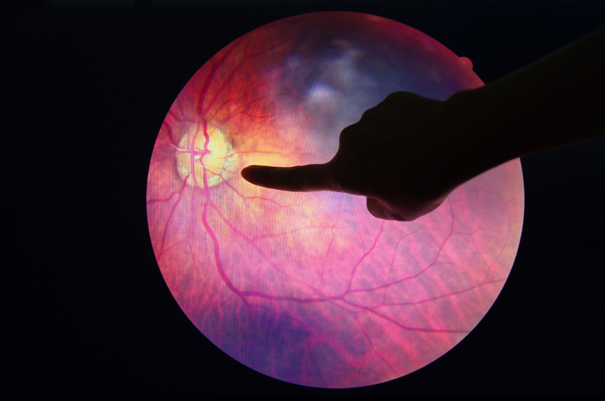 AI-driven eye screening aims to close the diabetic vision gap in community clinics