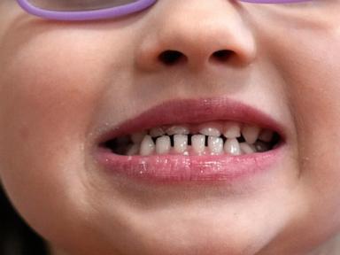 FDA restricts use of kids’ fluoride supplements, citing emerging health risks