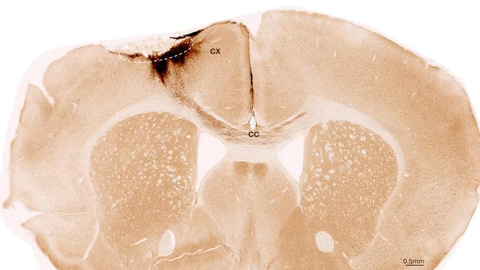 Stem Cell Stroke Therapy