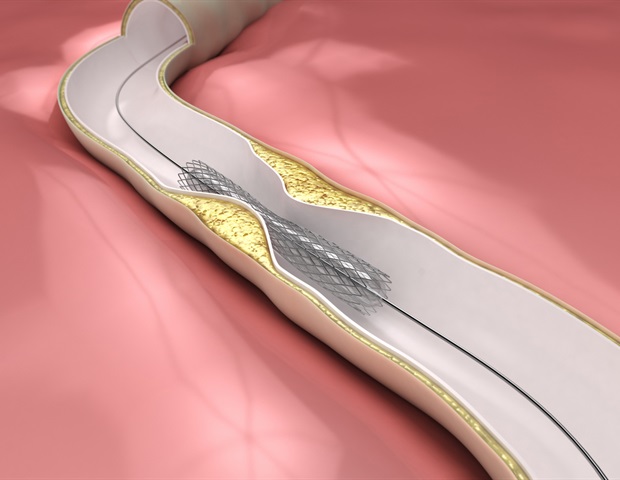 Sirolimus-eluting balloon emerges as a safe and effective option for coronary in-stent restenosis